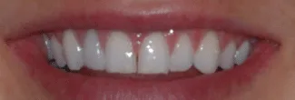 Before: four veneers to correct gum line and shade irregularities.