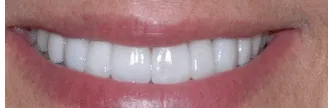 After: veneers to correct shade, spaces and extensive wear.