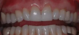 Before: gum surgery and veneers to correct gum line and wear issues.