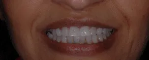 Before: invisalign and veneers to correct size discrepancy and severe wear patterns.
